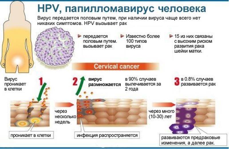 вирус папилломы человека у женщин